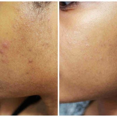 Do Face Brushes Help With Acne?