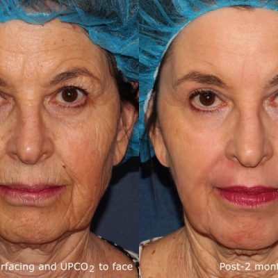 Which is the Best Laser for Deep Wrinkles?