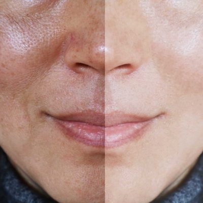 Is Melasma Permanent?