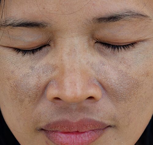 What is the Difference between Melasma And Hyperpigmentation?