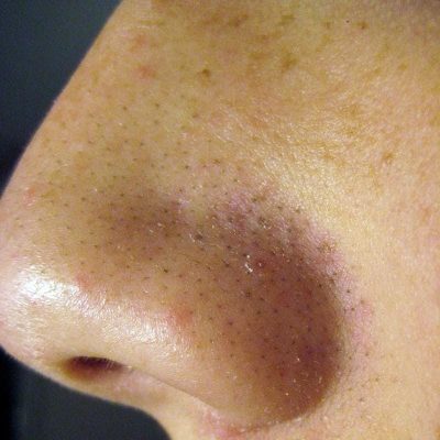 What is the Fastest Way to Cure Melasma?