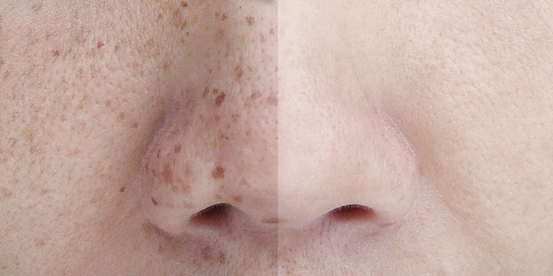 What Reduces Skin Melanin?