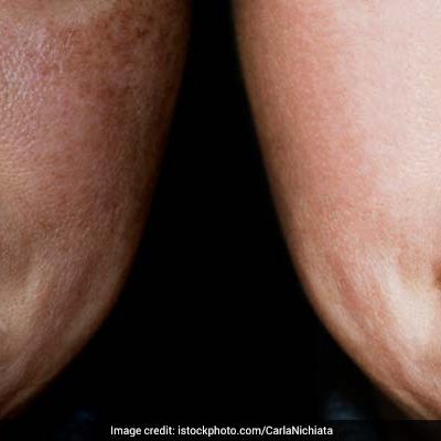 Which Dal is Best for Hyperpigmentation?