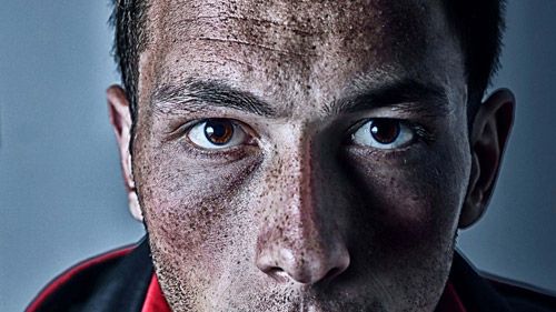 Which Fruit is Best for Remove Pigmentation?